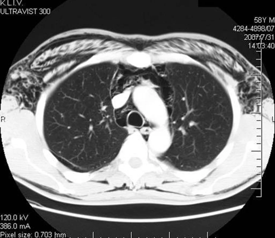 CT plic s podkožním emfyzémem
Fig. 6. Thorax CT with subcutaneous emphysema
