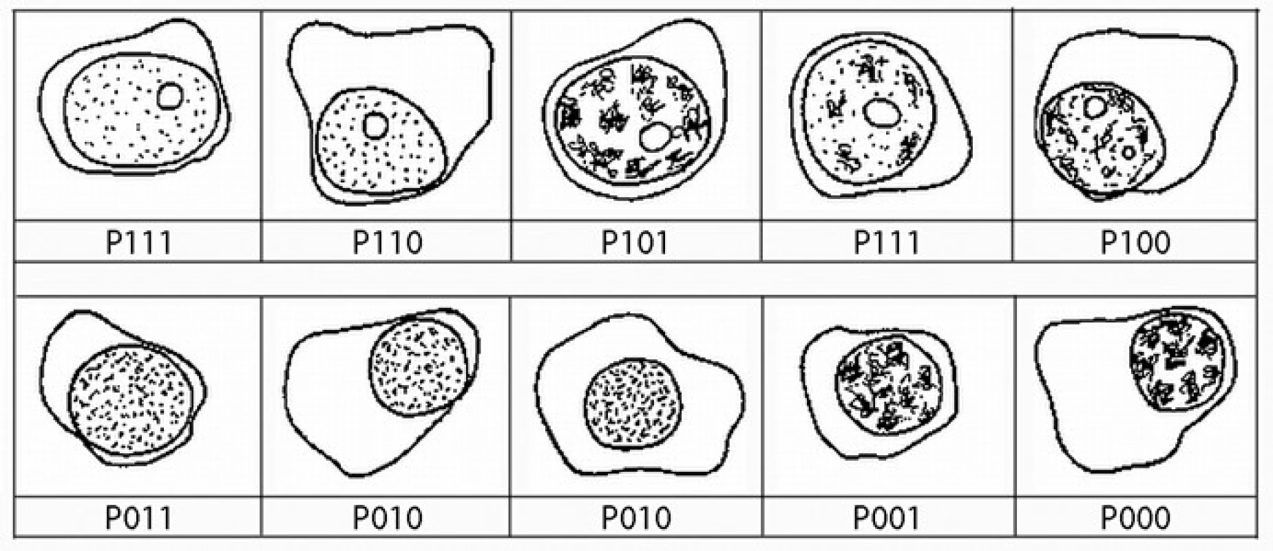 Přehledná zastoupení plazmatických buněk podtypů podle definice algoritmu systému plazmatická buňka, první číslo představuje přítomnost (1) nebo absenci (0) jadérka, druhé číslo představuje přítomnost (1) nebo nepřítomnost (0) blastického chromatinu, poslední číslo představuje přítomnost (1) nebo nepřítomnost (0) N: C poměru &lt; 0,6.
