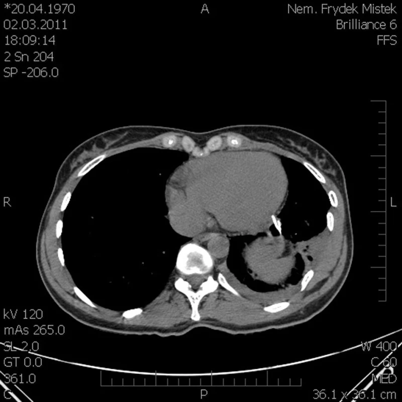 CT sken konec úlomku žebra zobrazený u hrotu srdečního, drobný hemoperikard, kontuze levé plíce
Fig. 2. CT scan – the end of the rib fragment is located near the heart tip, minor haemopericardium, left lung contusion
