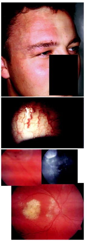 Sturgeův-Weberův syndrom manifestující se jako toxokarová chorioretinitida u 18letého muže. A) Naevus flammeus. B) Dilatované episklerální cévy pravého oka. C) Tvrdá ložiska v makule a choroidální hemangiom v periferii pravého oka