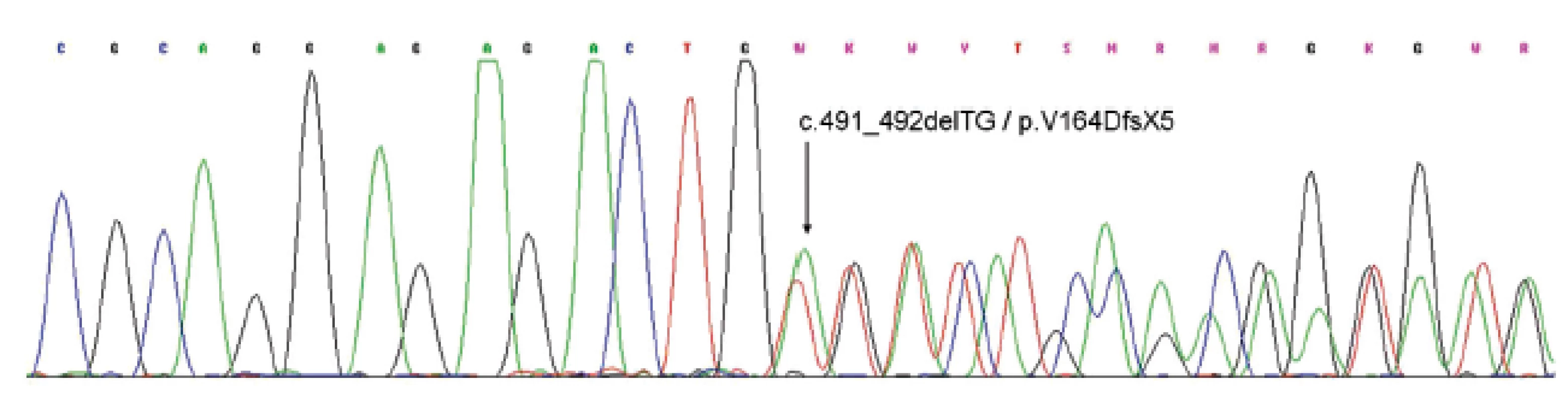 Sekvenogram části exonu 6 genu PRKAR1A. Šipka ukazuje začátek posunové mutace (delece tyminu a adeninu v pozici c.491 a c.492) vedoucí k posunu čtecího rámce a předčasnému stop kodonu.