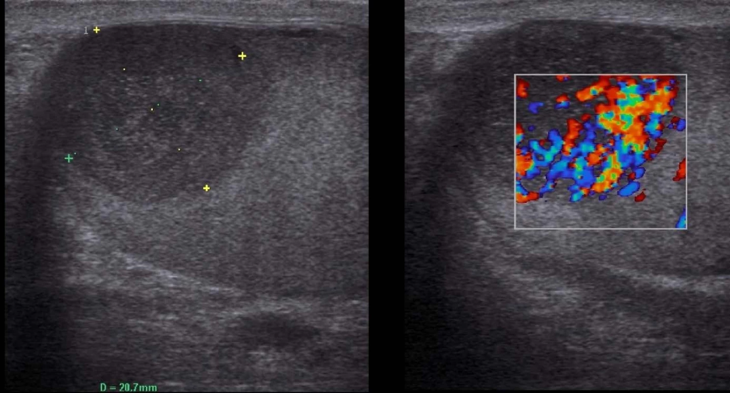 Sonografie varlete s lymfomem B-mode vlevo, hypervaskularizace tumoru při vyšetření dopplerem vpravo
Fig. 1. Ultrasonography of testis with lymphoma B-mode imaging in the left, hypervascularisation of the tumor in doppler imaging in the right