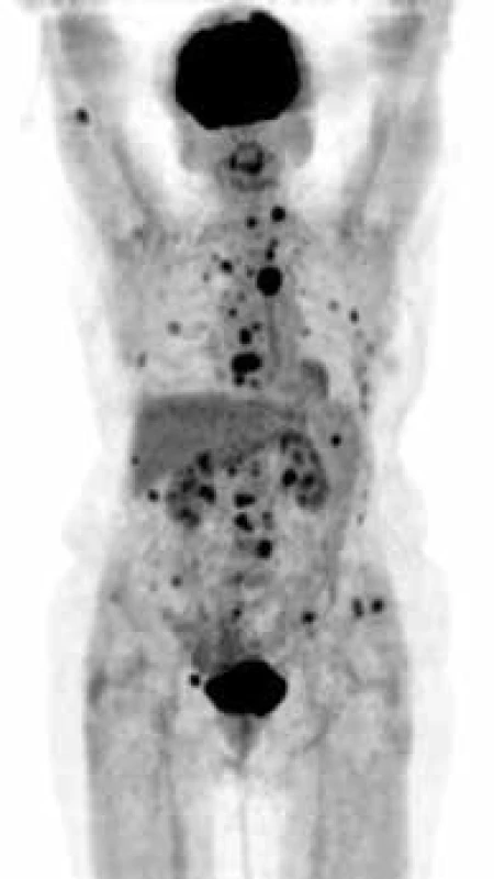PET CT zobrazení – forma MIP obraz (maximum intensity projections). Biodistribuce FDG ve snímané oblasti, mimo fyziologickou aktivitu (v mozkové kůře, patrových tonsilách, ledvinách a močovém měchýři) se zobrazují četná hypermetabolická ložiska ve skeletu od kalvy až po pánevní kosti