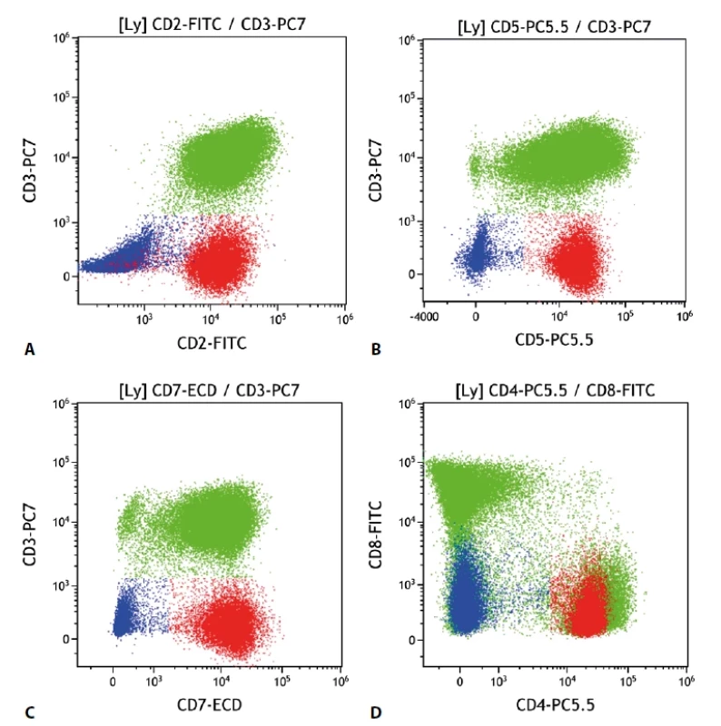 Periferní T buněčný lymfom. Průtoková cytometrie. Buňky PTCL červeně, B lymfocyty modře, ostatní T lymfocyty a NK buňky zeleně. A - patologická populace T lymfocytů s chybějící membránovou expresí CD3 a zachovalou expresí CD2, B - PTCL se zachovalou expresí CD5, C - PTCL se zachovalou expresí CD7, D - PTCL s pozitivní expresí CD4 a negativní CD8.