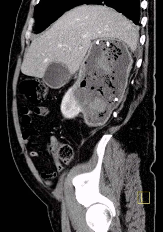 CT: sagitální řez cystickým ložiskem pravé ledviny po drenáži
Fig. 4. CT: sagital section at the level of the cystic lesion of the right kidney after drainage