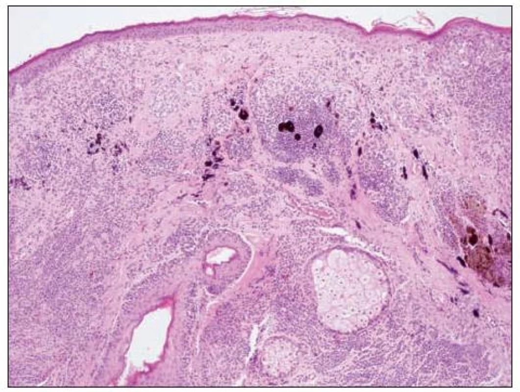 Névus intradermální na převážné části obrázku, na levé straně s melanocyty kolem adnex
Vpravo nahoře je melanom. Přechod mezi névem a melanomem je neostrý, přibližně v místě, kde je zřetelná hnědá pigmentace.