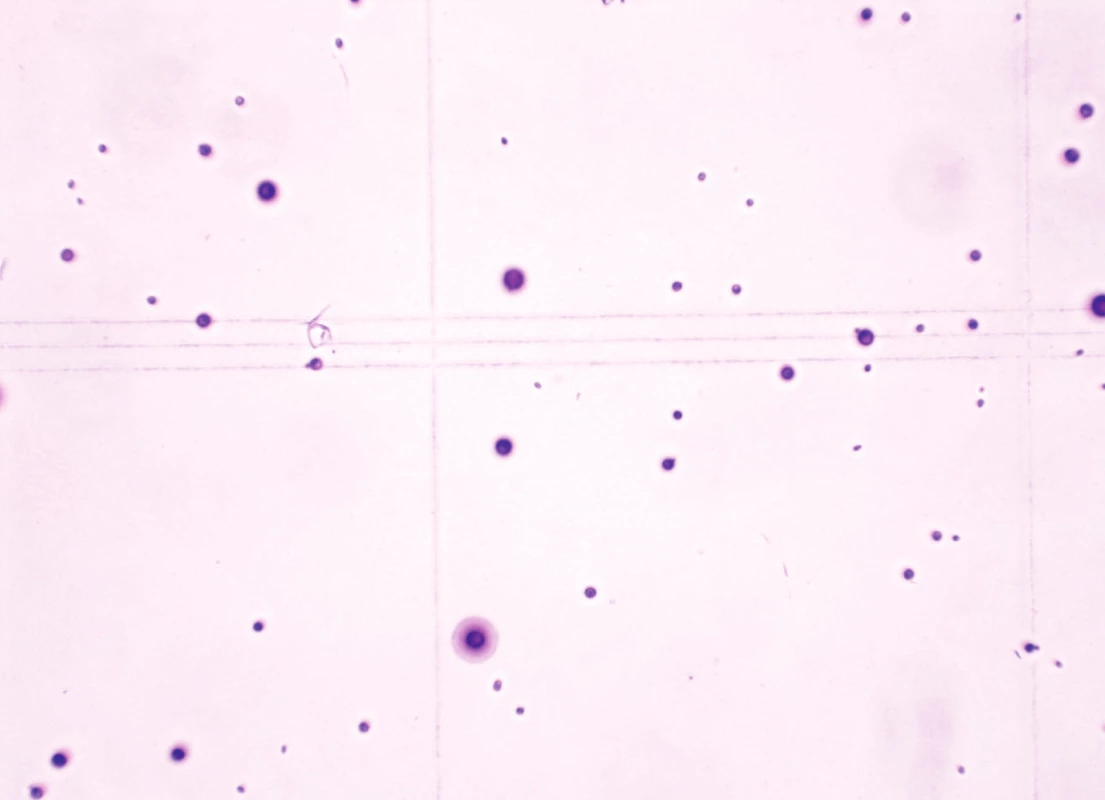 Mírná mononukleární pleocytóza s nálezem kulatobuněčných útvarů odpovídajícím buňkám krykptokokoka  po obarvení fuchsinem ve Fuchs-Rosenthalově komůrce (zvětšení 200x)
