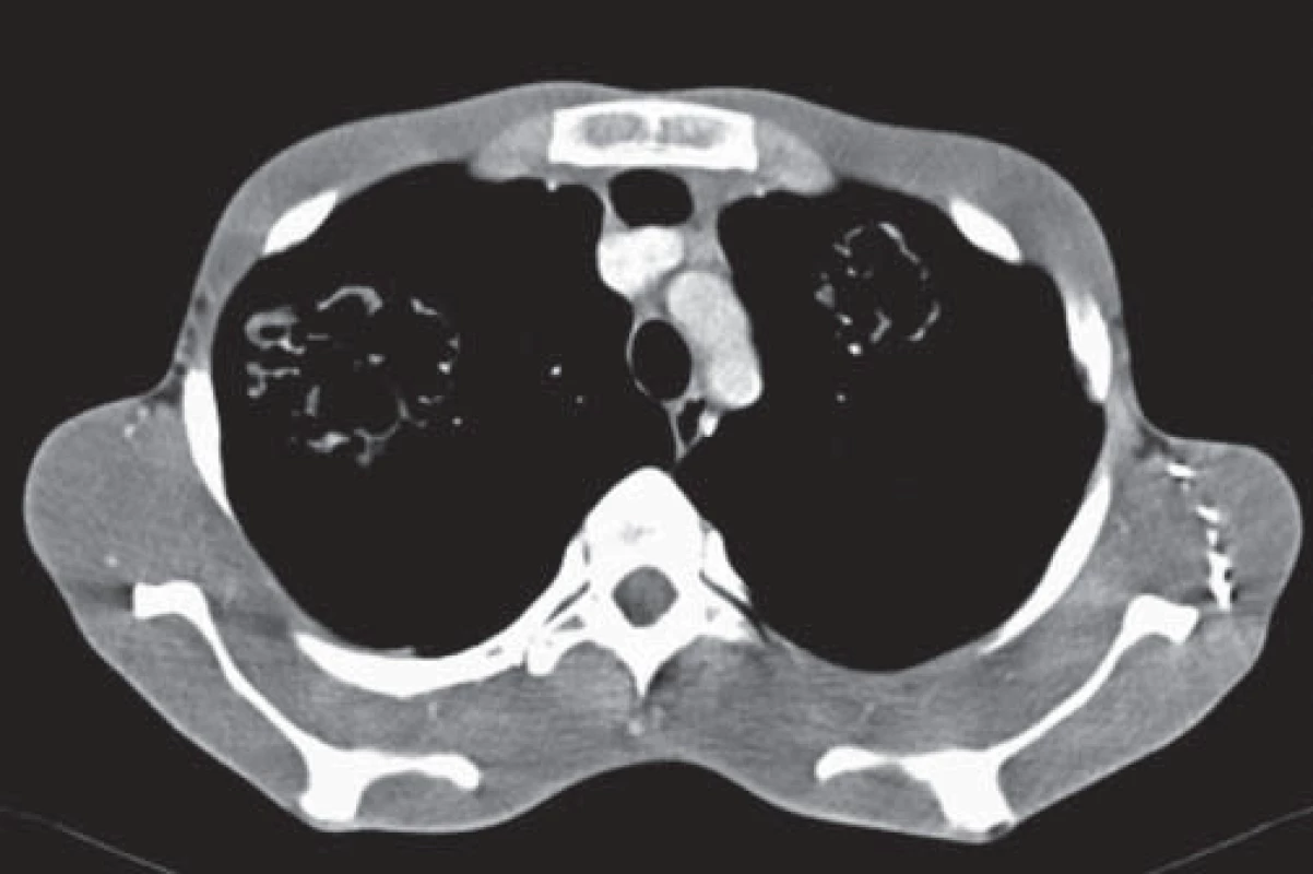 CT pľúc, 2014 – viditené bilaterálne parazitárne ložiská lamelárnej štruktúry.
Fig. 2. CT of the lungs, 2014 – visible bilateral parasitic foci of lamellar structure.