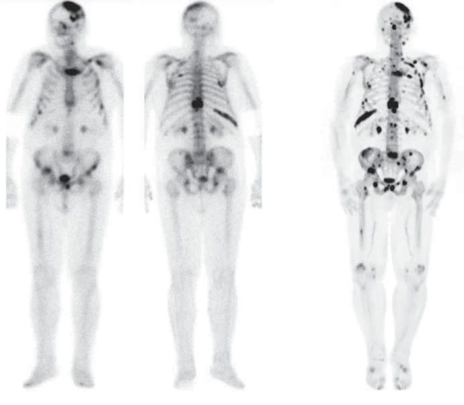 Příklad porovnání [&lt;sup&gt;99m&lt;/sup&gt;Tc]-MDP scintigrafie (dvojice vlevo, přední a zadní projekce) a [&lt;sup&gt;18&lt;/sup&gt;F]-NaF PET (vpravo, 3D sumovaný obraz, tzv. MIP) u téhož pacienta. Obě vyšetření jsou provedena zhruba ve stejném období, PET vykazuje vyšší senzitivitu (detekuje více ložisek), ale nižší specifitu (některá z ložisek nemusejí souviset s onkologickým postižením, může jít o příčinu jinou). Navíc je patrný i vyšší (lepší) kontrast v PET obrazu, menší aktivita v tělovém pozadí (background).