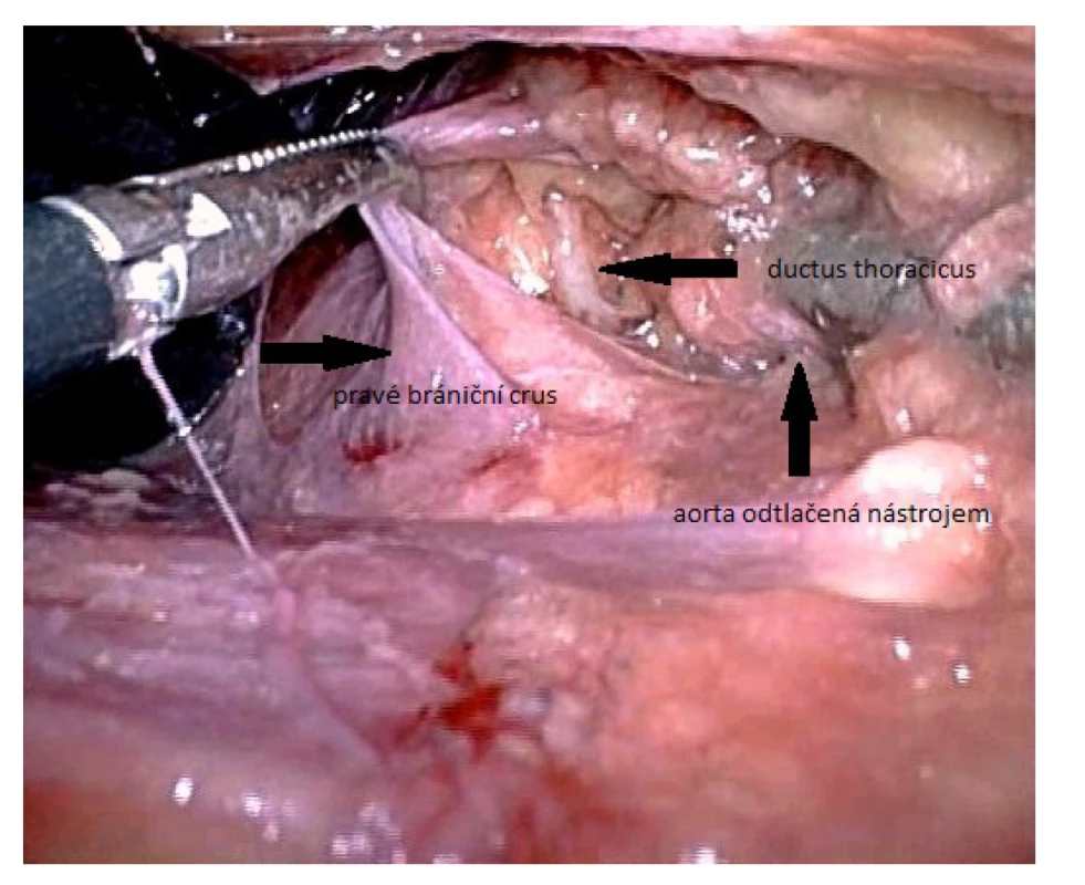 Identifikace ductus thoracicus u laparoskopického
přístupu v bráničním hiátu<br>
Fig. 4. Identification of the thoracic duct using laparoscopic
approach in the diaphragmatic hiatus