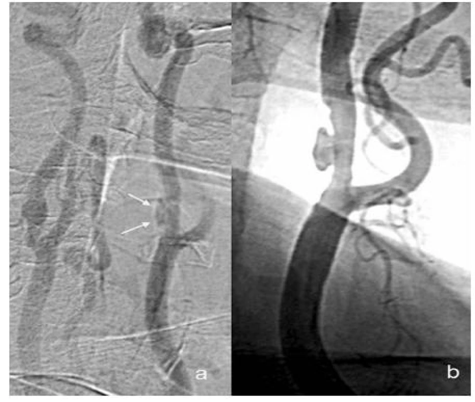 Exulcerovaný plát v DSA zobrazení – neselektivní nástřik do oblouku aorty (a), selektivní nástřik do levé společné karotické tepny (b)
