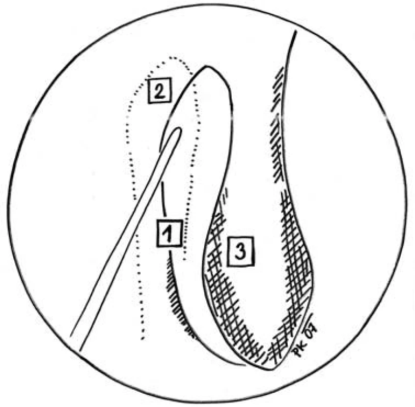 Identifikace polohy slzného vaku  - endonazální pohled na laterální nosní stěnu, umístění vaku vůči dalším strukturám. Špička intranazálně zavedené branže ukazuje na pravděpodobnou lokalizaci vaku. 1 – linea maxillaris, 2 – saccus lacrimalis, 3 – concha nasi media.