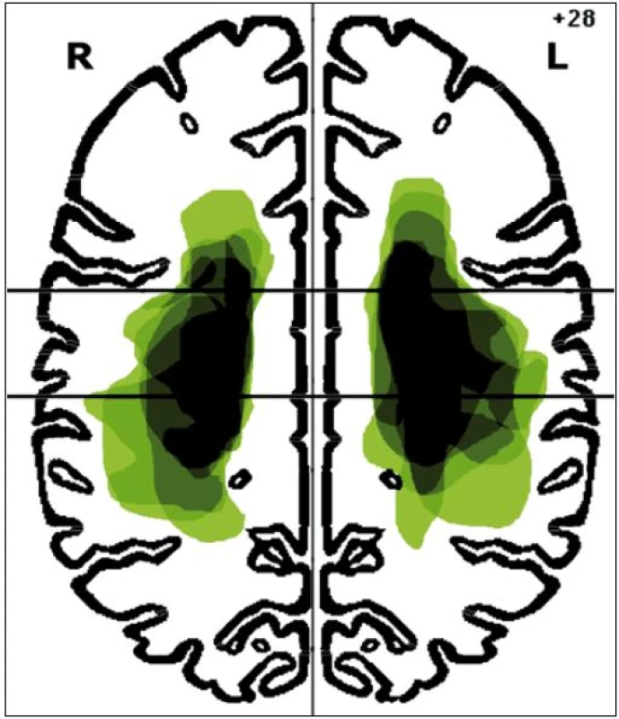 Lokalizace mozkových infarktů na úrovni z-souřadnice +28 mm Talairachova atlasu.