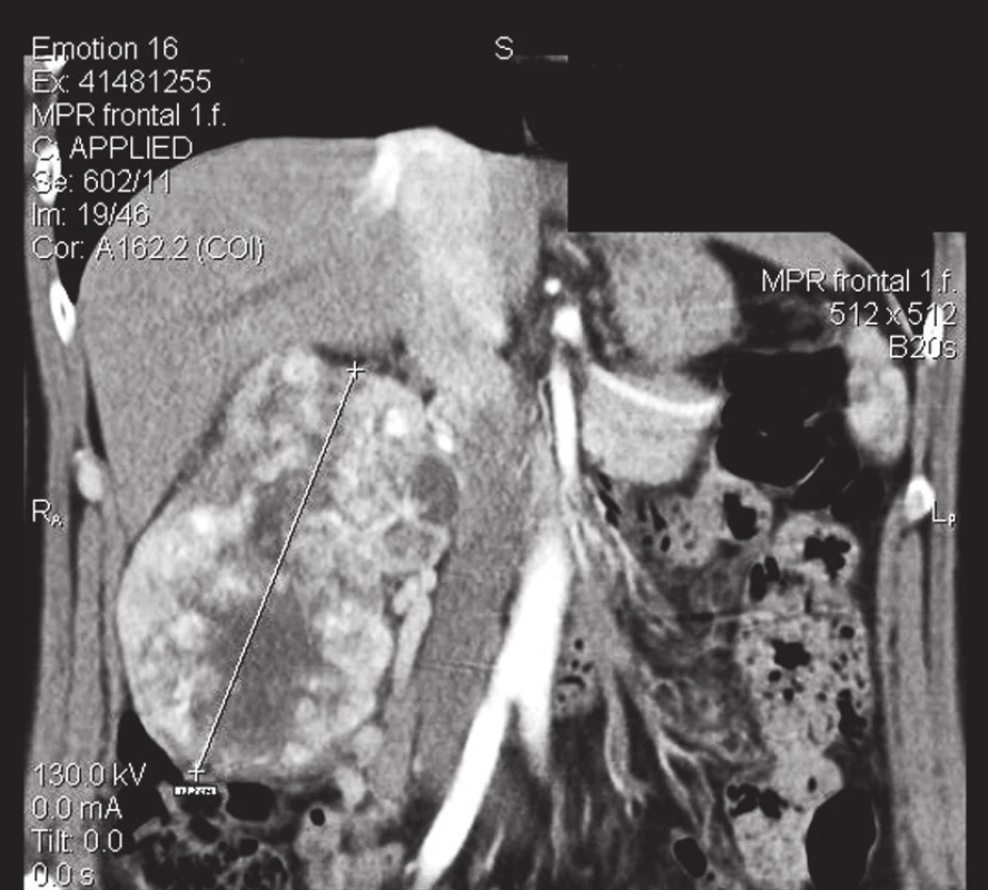 Tumor pravé ledviny
Fig. 1. The tumor of the right kidney