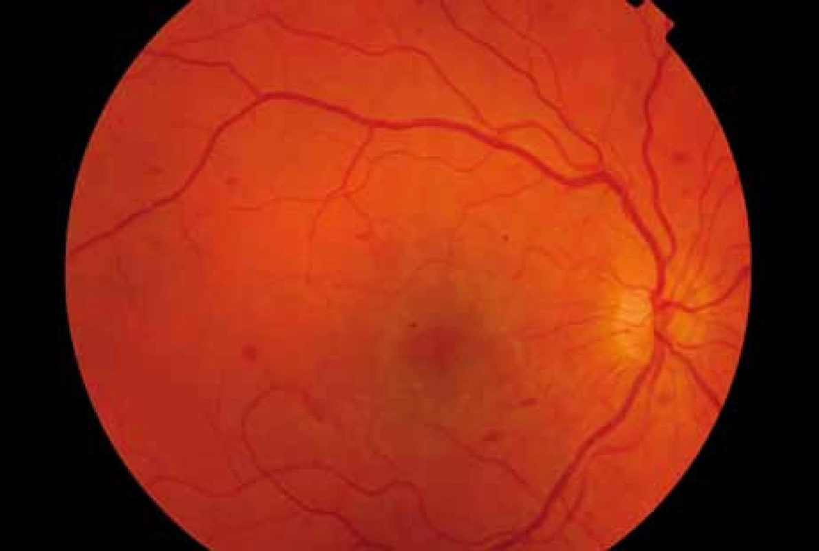 Barevný snímek fundu pravého oka v 26. týdnu gravidity s přibývajícími hemoragiemi na sítnici.