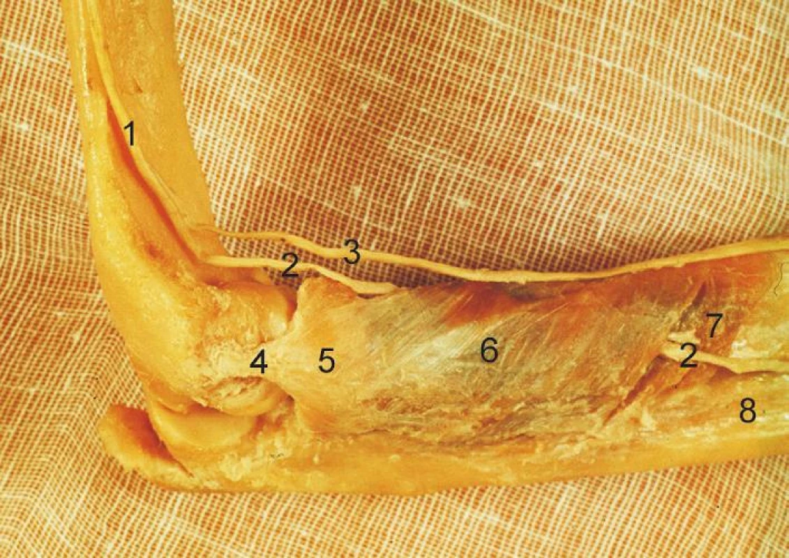 Komplex lig. collaterale lat. a m. supinator: 1 – n. radialis, 2 – r. profundus n. radialis, 3 – r. superficialis n. radialis, 4 – lig. collaterale lat., 5 – lig. anulare radii, 6 – povrchová vrstva m. supinator, 7 – hluboká vrstva m. supinator, 8 – ulna. &lt;i&gt;(Převzato z Bartoníček J, Heřt J. Základy klinické anatomie pohybového aparátu. Praha, Maxdorf 2004.)&lt;/i&gt;
Fig. 4: Lateral collateral ligament complex and the supinator: 1 – radial nerve, 2 – deep branch of radial nerve, 3 – superficial branch of radial nerve, 4 – lateral collateral ligament, 5 – radial annular ligament, 6 – superficial layer of the supinator, 7 – deep layer of the supinator, 8 – ulna.&lt;i&gt;(Reprinted from Bartoníček J, Heřt J. [Outline of Clinical Anatomy of Musculoskeletal Apparatus]. Praha, Maxdorf 2004.)&lt;/i&gt;