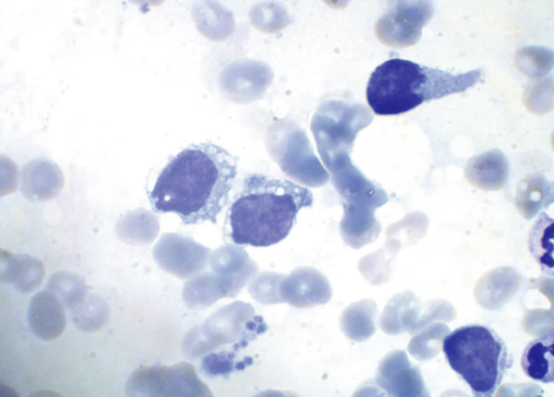 Nátěr kostní dřeně (kazuistika 1) při leukemizaci onemocnění
Uprostřed dva blastické elementy střední velikosti s jemným jaderným chromatinem a patrnými jadérky a objemnější cytoplazmou s četnou vakuolizací. Vpravo dva elementy s výběžky cytoplazmy typu pseudopodií. V dolní části shluk trombocytů.
