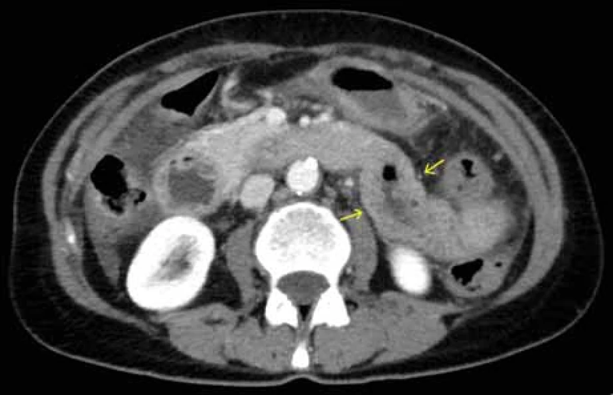 CT břicha – zesílená stěna orálního jejuna.