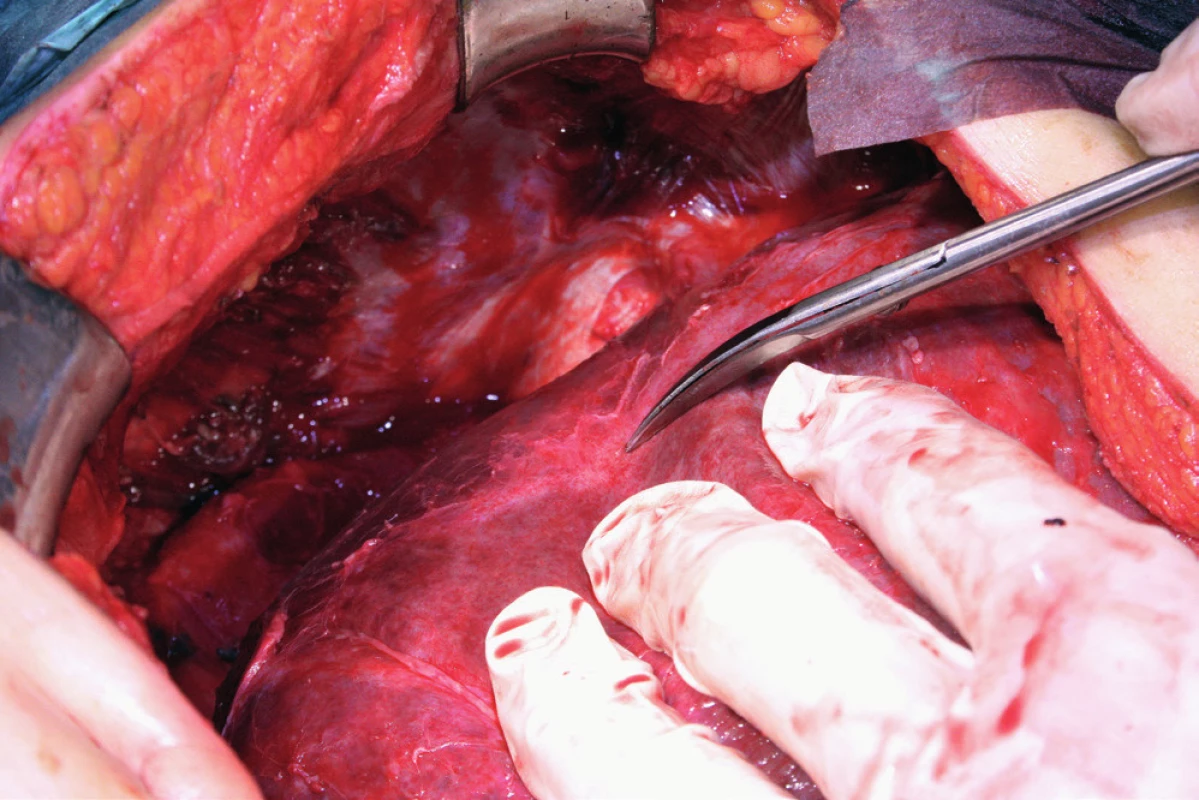 Stav po mobilizaci jater, nůžky ukazují linii disekce ligamentum coronarium a triangulare hepatis