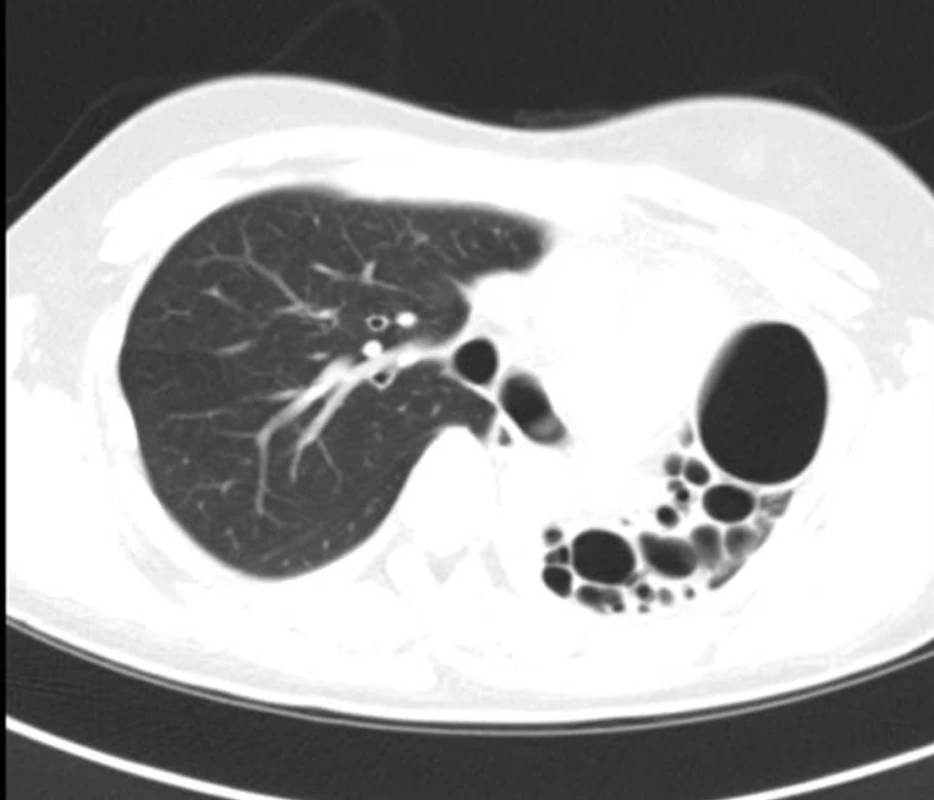 Počítačová tomografie (CT) hrudníku nemocné s bronchiektáziemi na podkladě vrozené vývojové vady levé plíce