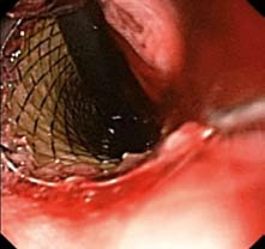 Distální konec stentu po zavedení přesahující kardii (endoskopický obraz).
Fig. 10. Distal end of the stent after application overlapping cardia (endoscopic image).