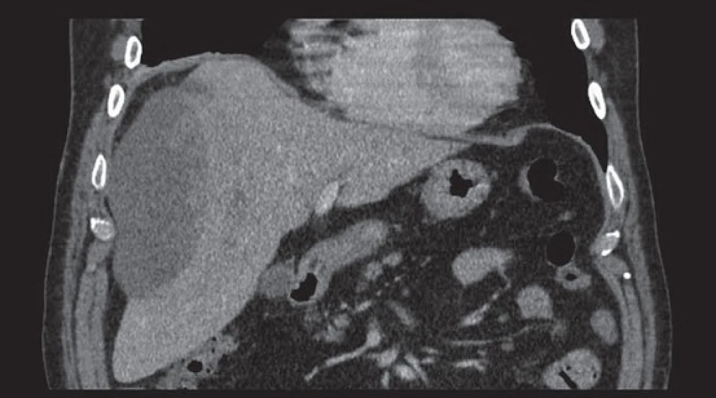 Objemný subkapsulární hematom bez průkazu leaku kontrastní látky do hematomu či peritoneální dutiny.
Fig. 2. Large subcapsular haematoma, without signs of contrast leakage into the haematoma or peritoneal cavity.