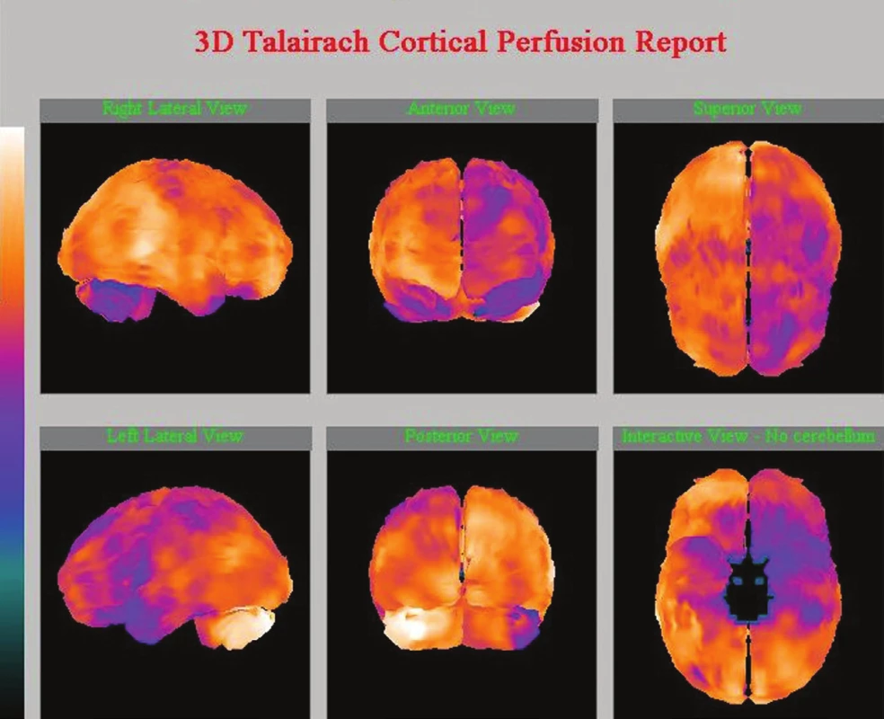 SPECT mozku – ukázka bazální a zátěžové studie (dipyridamolový test); hodnocení semikvantitativní programem NeuroGam&lt;sup&gt;TM&lt;/sup&gt;Segami. Významně snížená CVR oboustranně u 76leté pacientky po recidivující iCMP (vlevo a dole).