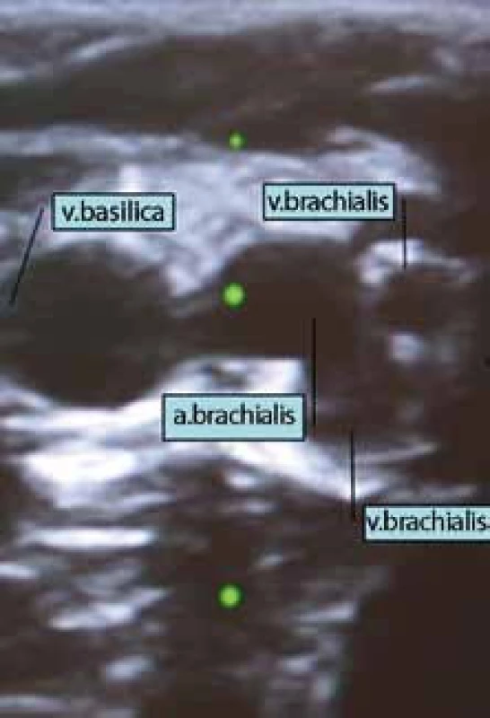 Ultrazvukový obraz cév paže. Vpravo a. brachialis se dvěma sousedícími vv. brachiales, vlevo v. basilica.
