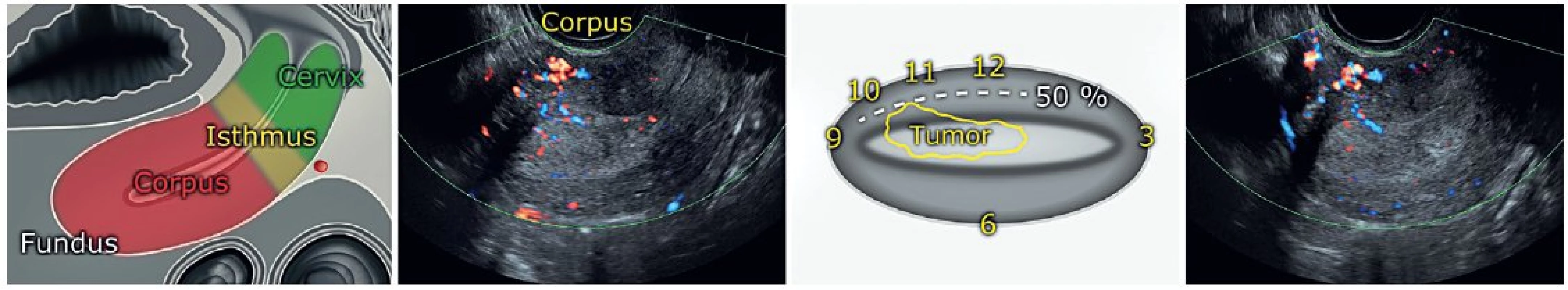 Ultrazvuková lokalizace místa nejhlubší invaze endometriálního nádoru do myometria