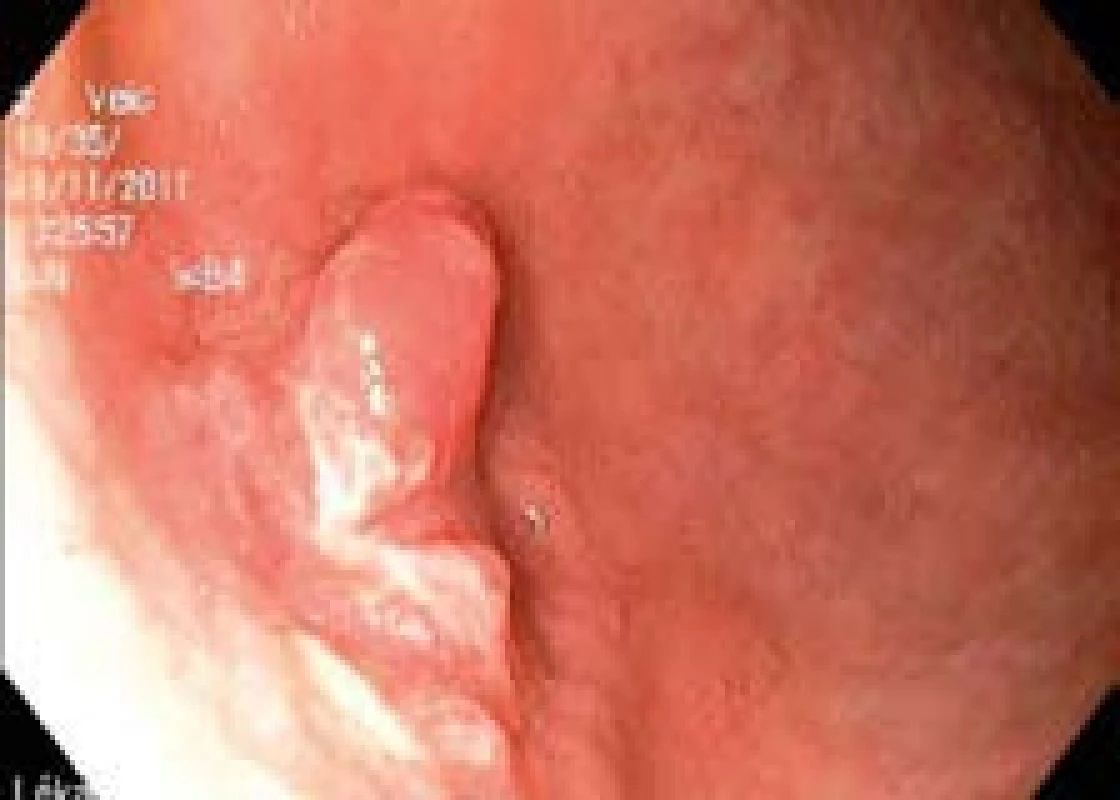 Povrchová neoplastická léze typu 0-IIc + Is v žaludku.
Fig. 1. Type 0-IIc + Is superficial neoplastic lesion in the stomach.
