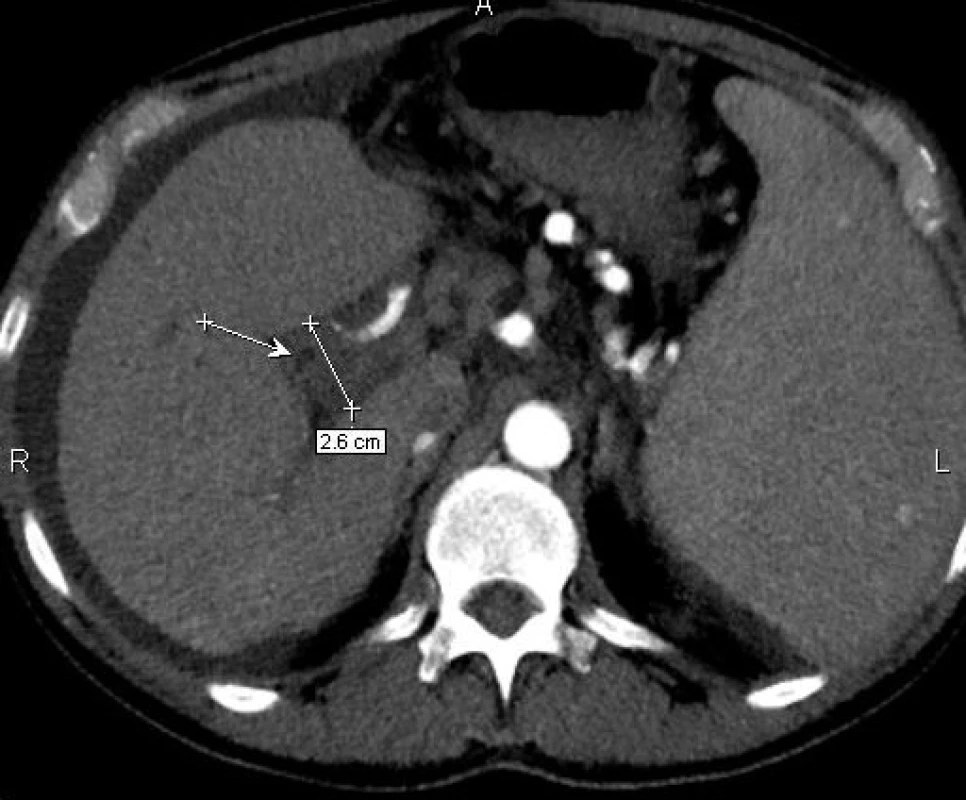 Kontrastní CT vyšetření v arteriální fázi s masou v hilu jater a kompenzatorně hypertrofickou a. hepatica
Šipka ukazuje na lumen choledochu.