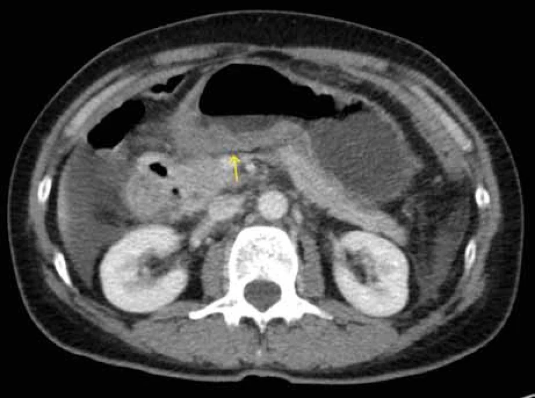 CT břicha – zesílená stěna aborální části žaludku dorzálně (šipka), volná tekutina v dutině břišní.