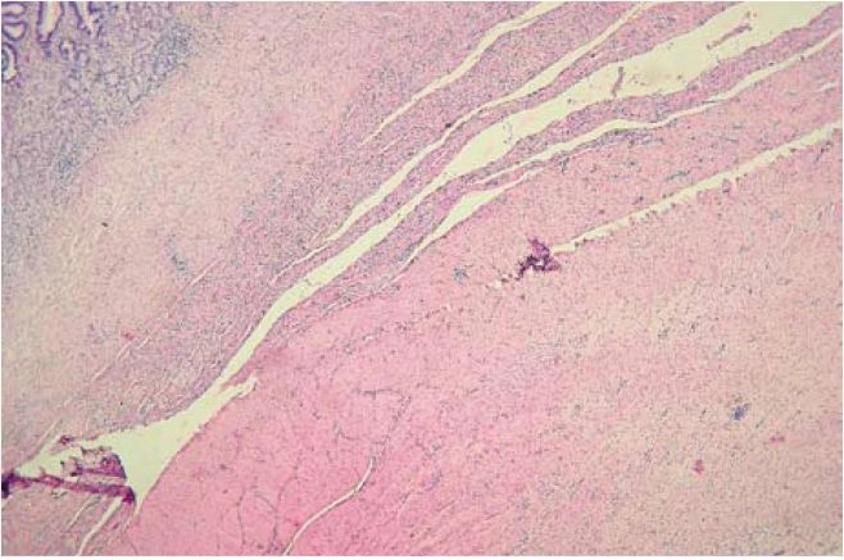Histologický obraz jizvy zhojené v celé šíři stěny žaludku.
Fig. 4. Histological image of the healed scar in the whole abdominal wall width.