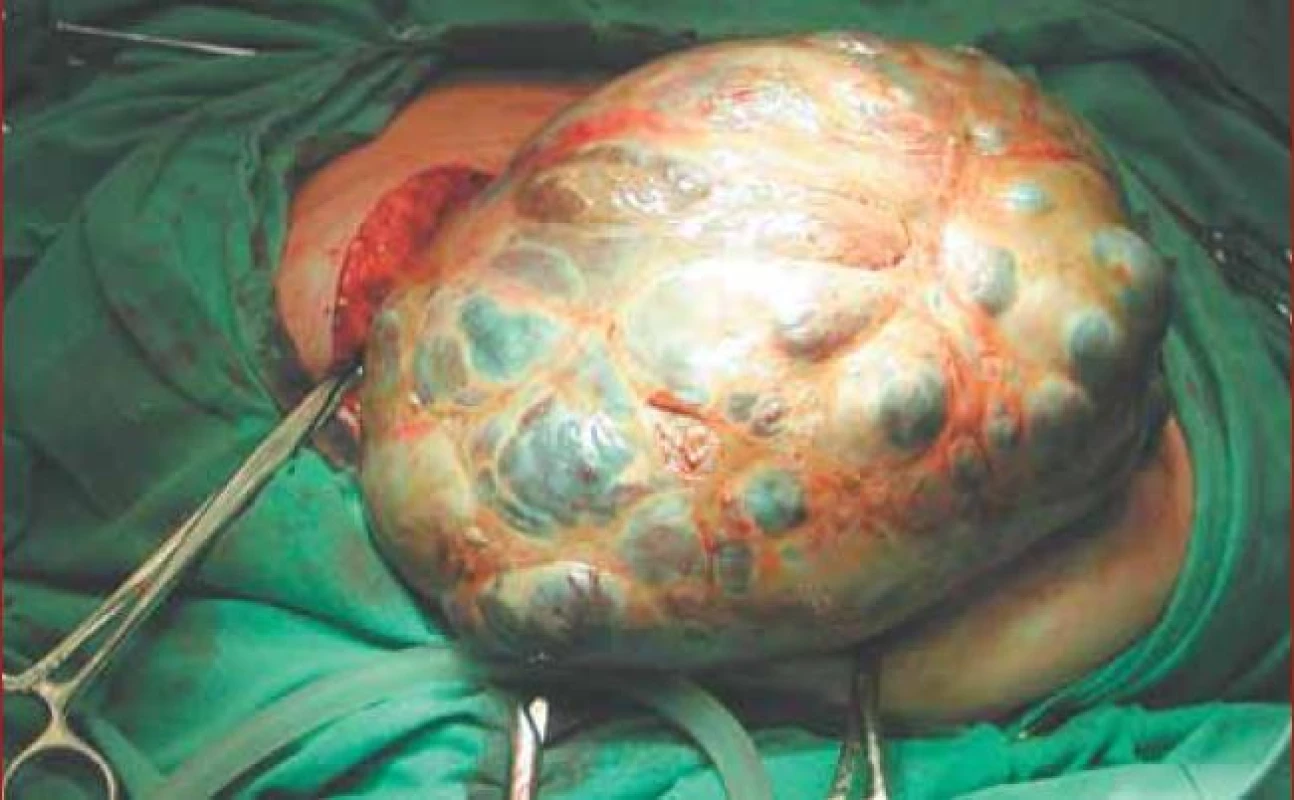 Peroperační nález karcinomu ovaria.