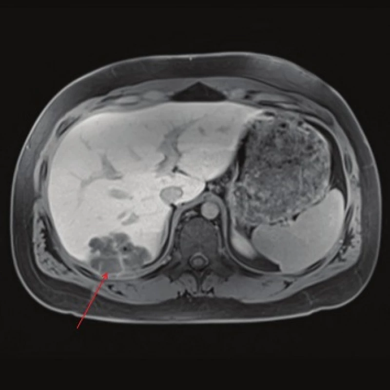 MRI, T1 weighted image following contrast administration, late phase: the cystic component consisting of a colliquative necrosis (red arrow) is clearly visible. Smaller cystic lesions corresponding to the parasite´s cysts are also visible. A calcification visible as a black point is present.