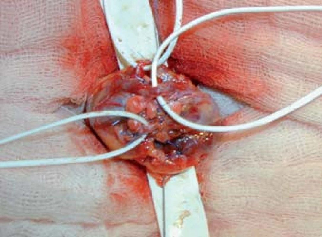 Identifikace testikulární arterie, podvaz a přerušení testikulárních žil.