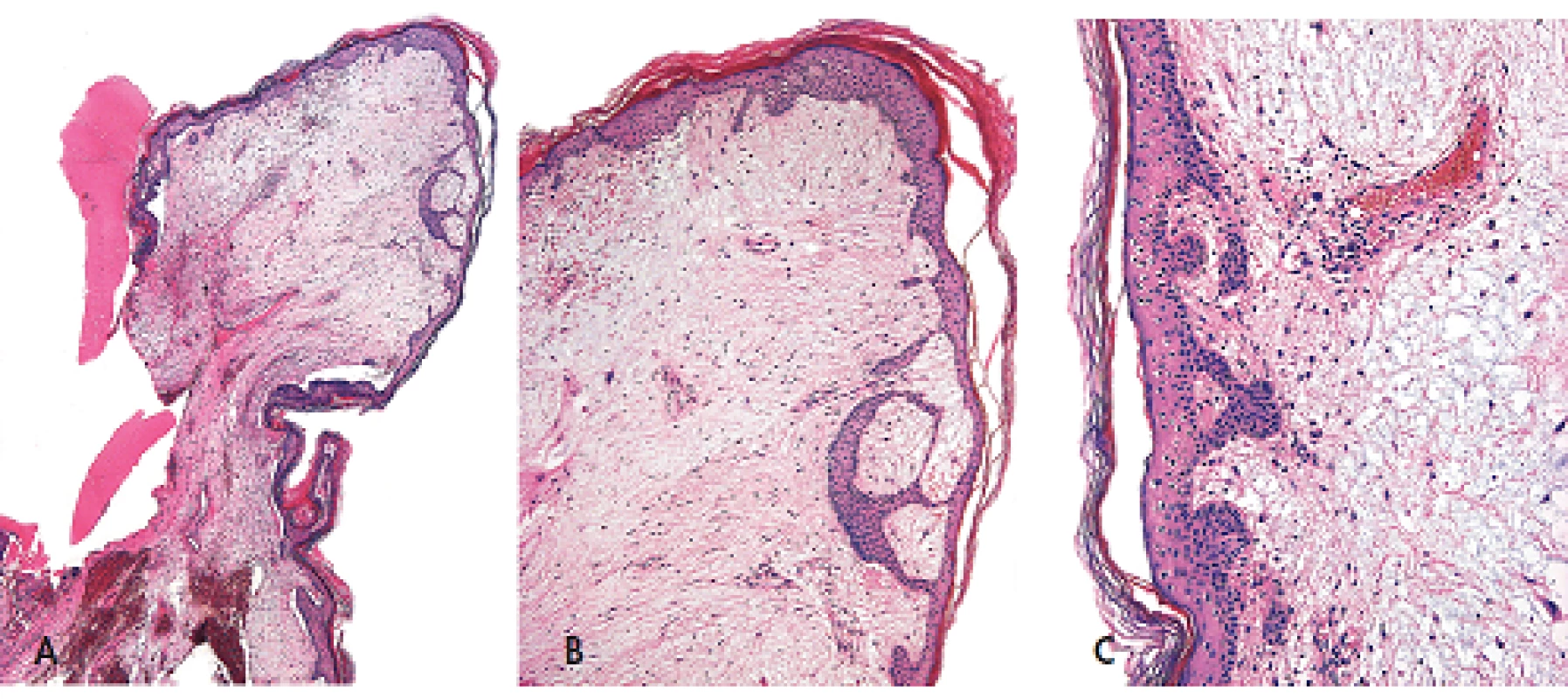 Kožní myxom polypovitého tvaru pocházející ze zevniho zvukovodu (A, zvětšení 20x) s nápadnými změnami epidermis nad ním ležící. Tyto změny mají podobu navzájem propojených pruhů epitelových buněk s periferním palisádováním (B, zvětšení 40x; C, zvětšeni 100x). Barveno hematoxylinem eozinem.