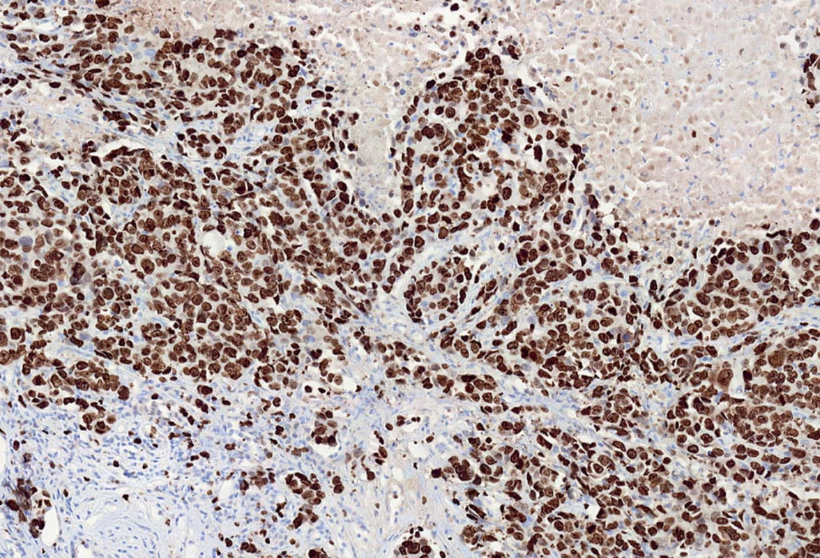 Index proliferační aktivity nádorové populace odpovídá procentu jader karcinomových buněk pozitivních s MIB1 protilátkou.