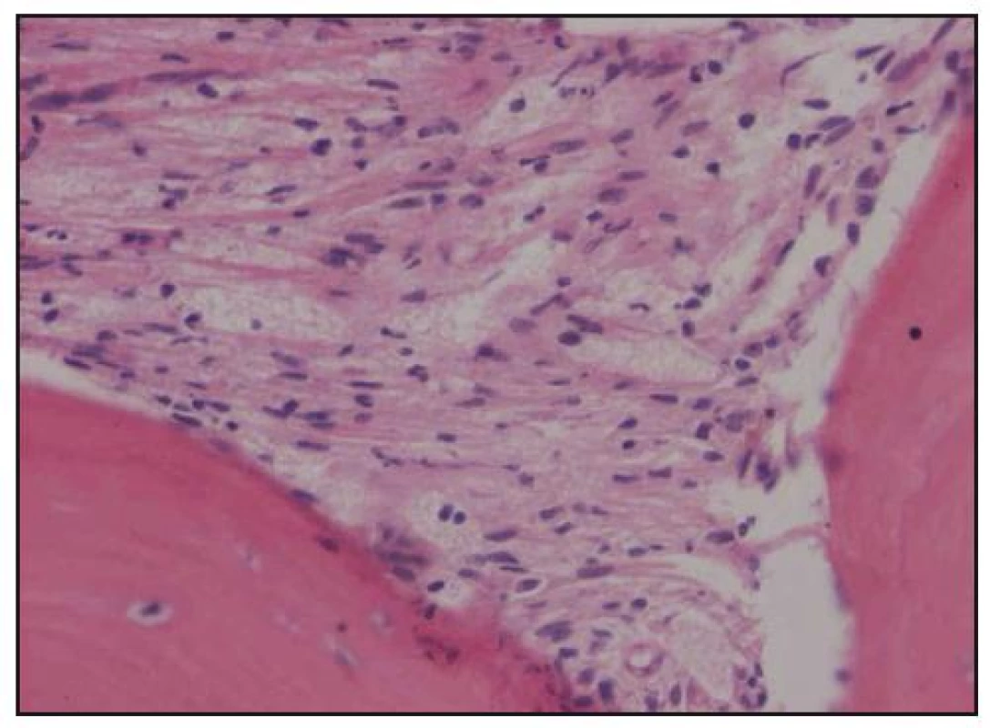 Histologické hodnocení válečku kostní dřeně. Barvení hematoxylin-eozin, zvětšení 200krát. Pěnité a vřetenité histiocyty nahrazují hemopoetické buňky kostní dřeně.
