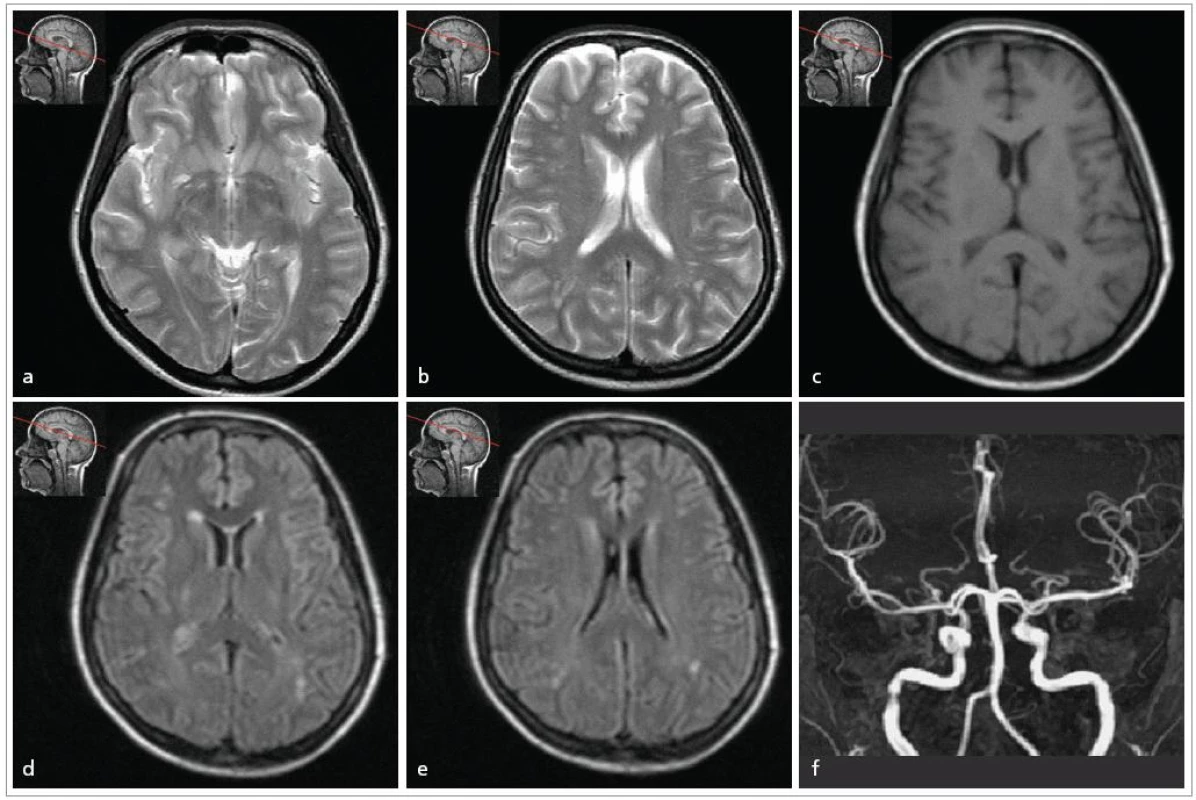23letá pacientka s migrénou bez aury s frekvencí záchvatů 3krát měsíčně, vyšetřena těsně před těhotenstvím.
1,5T MRI vyšetření mozku:
a, b) T2 vážený obraz modu TSE
c) T1 vážený obraz modu TSE
d, e) FLAIR, transverzální řezy
f) MRI angiografie mozkových tepen, MIP rekonstrukce
V T2 vážených obrazech (obr. a) jsou rozšířené Virchowovy-Robinovy prostory v hloubi hemisfér. V bílé hmotě obou hemisfér, převážně subkortikálně, jsou drobné ložiskové hyperintenzity v T2 vážených obrazech a FLAIR (obr. b, d, e), bez korelátu v T1 vážených obrazech (obr. c). Normální MRA.