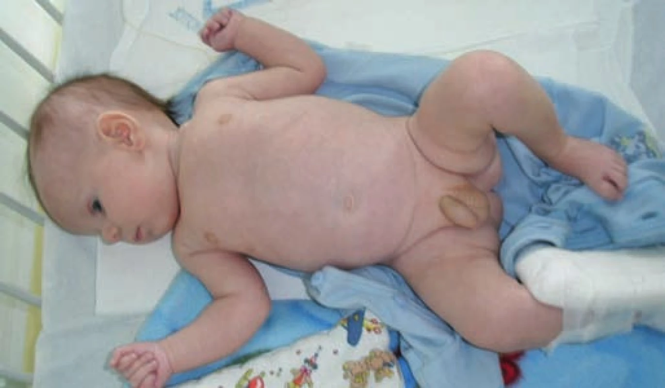 Pacient ve věku 2,5 měsíce.
Fig. 1, Patient at the age of 2.5 months.