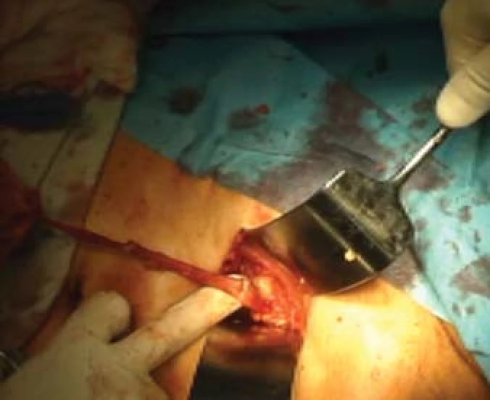 Krátký pararektální řez vlevo, jímž byla extrahována v sáčku uložená ledvina (na obrázku vlevo) a nyní bude preparován distální ureter. Na ureteru je nad prstem patrný klip z obr. 3.