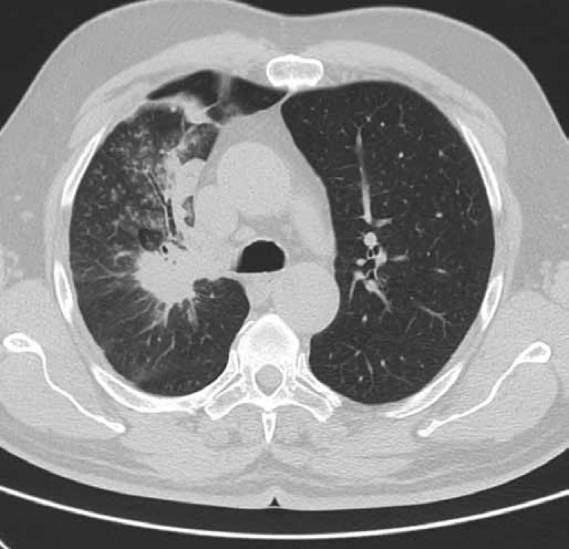 CT hrudníku pacienta č. 1 v době zahájení léčby erlotinibem (únor 2011).
Obrázek zobrazuje tumor horního laloku pravé plíce a související dys-/atelektatické změny v oblasti horního laloku pravé plíce.