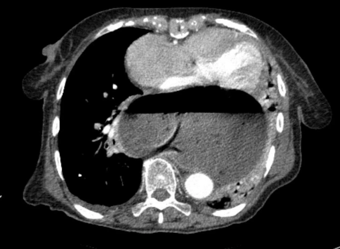 Axiální snímek CT
Fig. 9: Axial CT image
