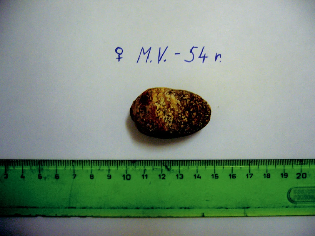 Žlčový kameň veľkosti 5x3 cm, ktorý spôsobil biliárny ileus
Fig. 10. Acholedocholith measuring 5x3 cm, which cased the biliary ileus