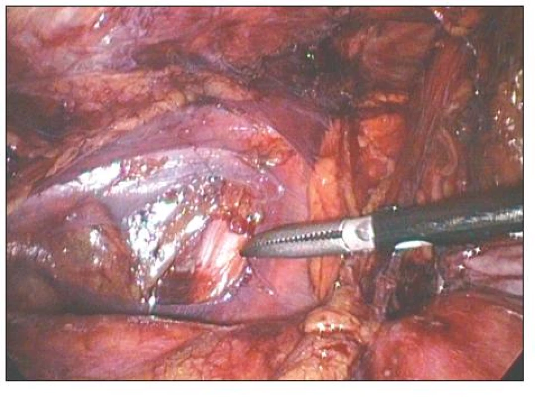 TAPPlevého třísla. Špička disektoru ukazuje na r. femoralis n. genitofemoralis
Fig. 2. TAPPof the left groin. The dissector tip points at r. femoralis n. genitofemoralis