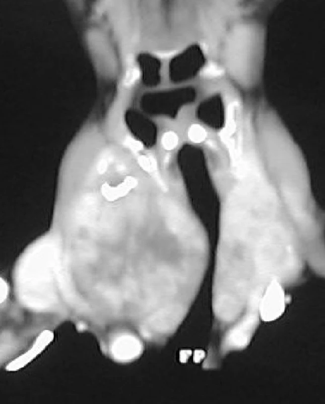 Stenoza průdušnice – CT sken
Fig. 2: Stenosis of the trachea – CT scan
