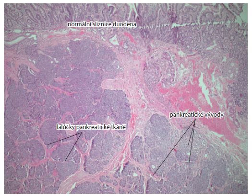 Normální duodenální sliznice, acini, pankreatické vývody.
Barvení hematoxylin-eozinem, zvětšení 5×.<br>
Fig. 4. Normal duodenal mucosa, acini, pancreatic ducts. Haematoxylin and eosin
staining, magnification 5×.
