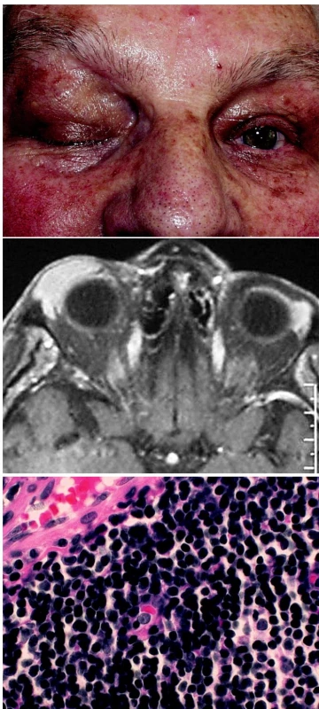 a. Ptóza horního víčka vpravo podmíněná tumorózním vyklenutím
b. MR: tumorózní prominence horního víčka vpravo
c. Histologie: MALT-lymfom, parafin. řez, barvení hematoxylin- eosin, zvětšení 500krát