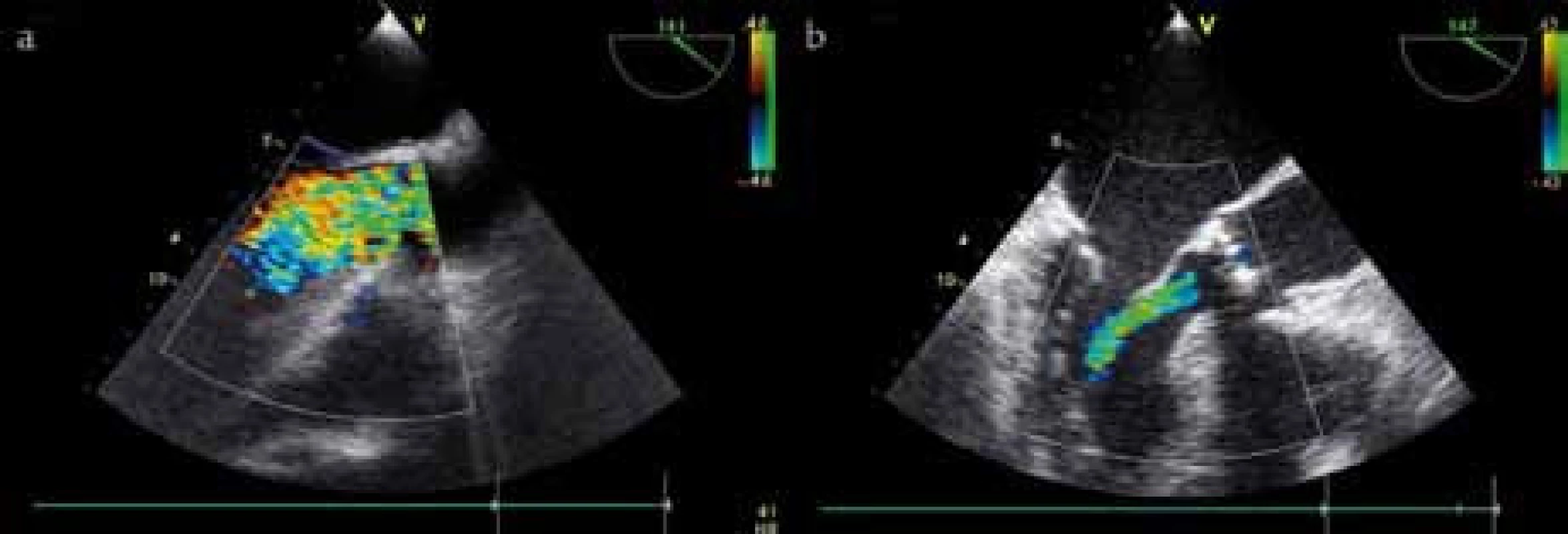 a) Významná aortální regurgitace v barevném dopplerovském vyšetření (vena contracta vyplňuje celou šíři LVOT). b) Středně významná aortální regurgitace v barevném dopplerovském vyšetření (vena contracta 5 mm, délka jetu do 1/2 levé komory).